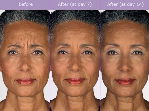 botox-before-and-after-pictures.jpg